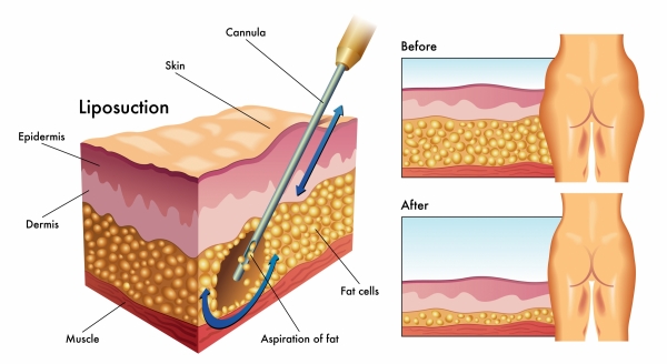 How Liposuction Works | Miami Liposuction