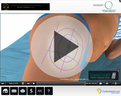 Liposuction in Ft. Lauderdale | Miami | Weston Ultrasonic Liposuction