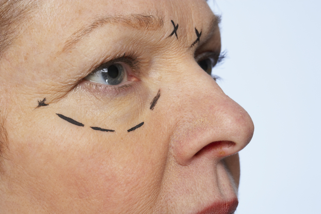 Eyelid Surgery in Weston, FL