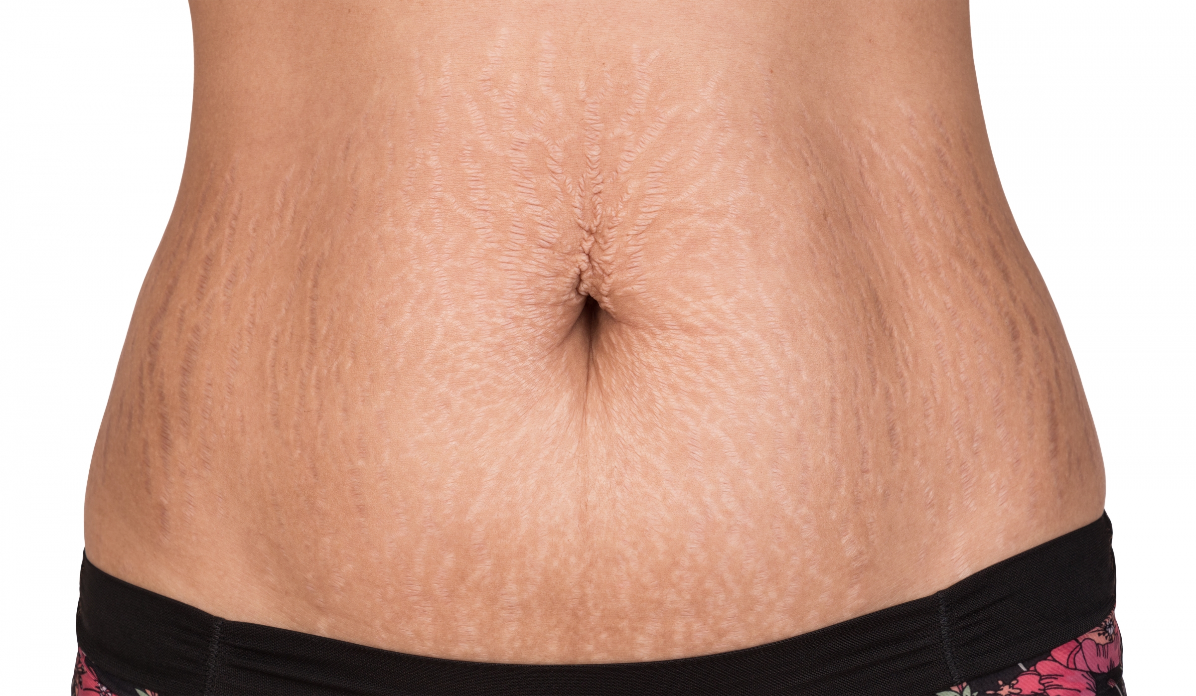 Stretch marks cannot be treated, but they can be removed during a body contouring procedure. To learn more in Southern Florida, contact the Weston Center for Aesthetic Medicine & Surgery today