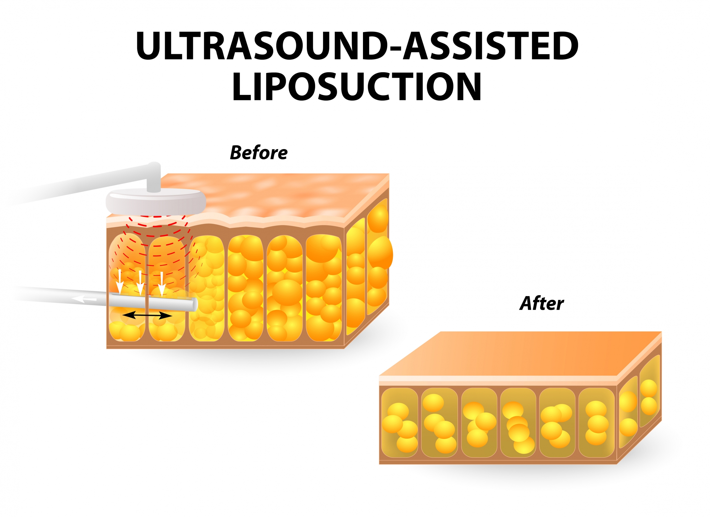 Ultrasonic Lipo in Miami