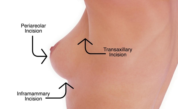 3 Types Of Breast Augmentation Incisions