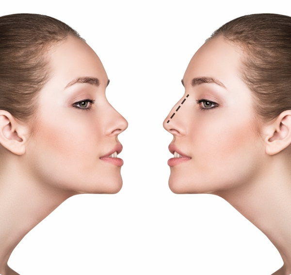 Nasal Septal Surgery (Septoplasty) | Miami, Ft. Lauderdale