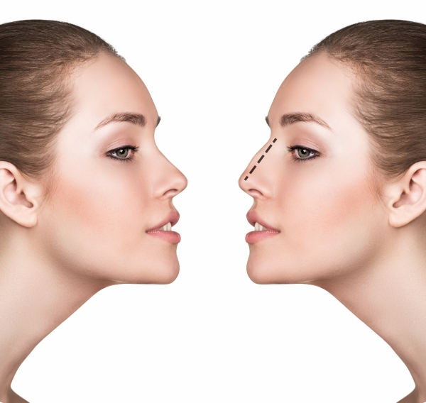 Nasal Septal Surgery (Septoplasty) | Miami, Ft. Lauderdale